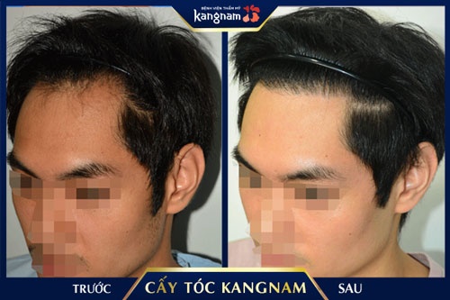 Kết quả cấy tóc tại BVTM Kangnam cấy tóc tại hàn quốc