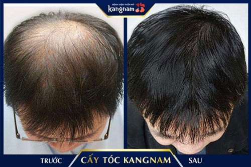 cấy tóc ở tphcm