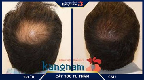 Hói nặng vùng đỉnh đầu đã được khắc phục đến 90% cấy tóc prp