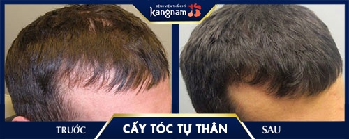 cấy tóc kangnam