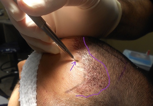 tác hại của cấy tóc tự thân