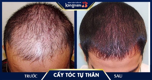 cấy tóc tự thân có an toàn không