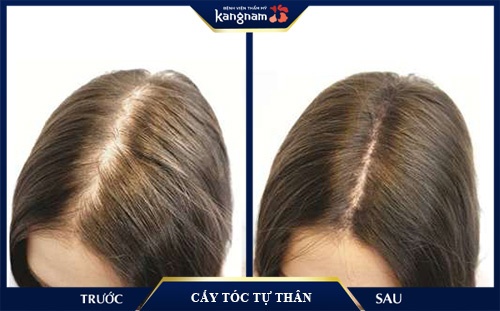 cấy tóc tự thân tại kangnam có đau không cấy tóc tự thân có đau không