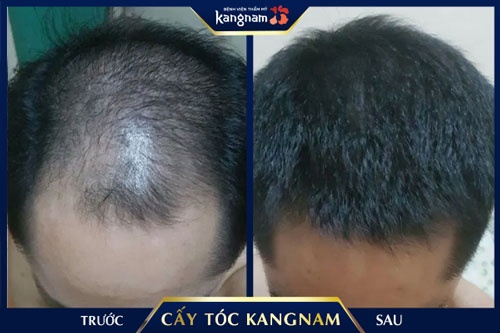 Kết quả cấy tóc ở đâu tốt cấy tóc ở đâu tốt