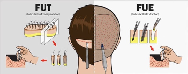 Các công nghệ cấy tóc tại BVTM Kangnam cấy tóc fue ở đâu