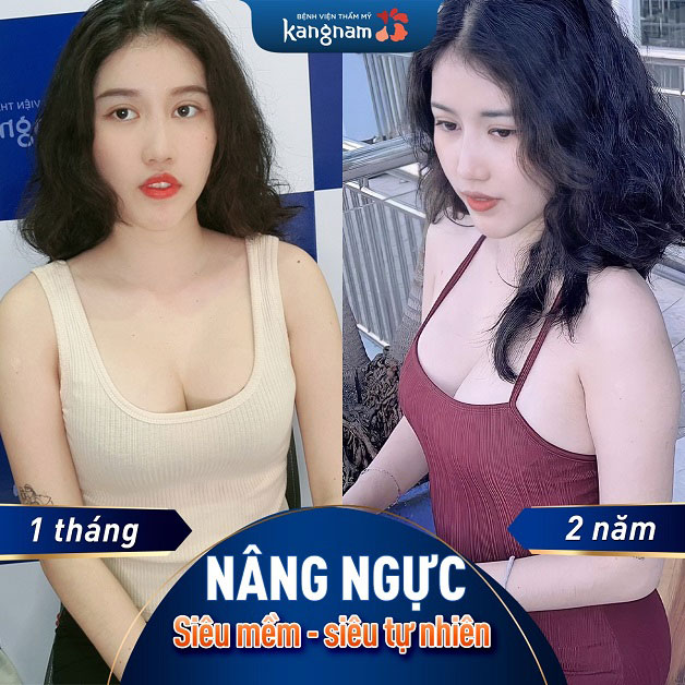 Nâng ngực siêu mềm, siêu tự nhiên