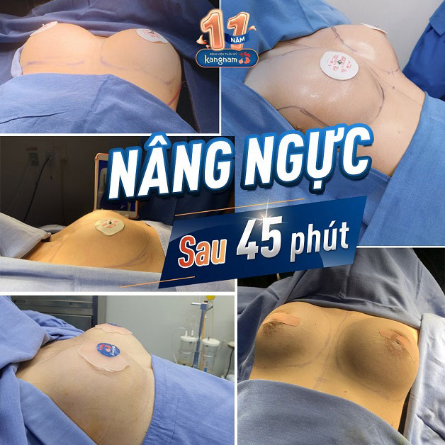 Nâng ngực sau 45 phút tại Kangnam