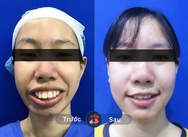 Kết quả khách hàng sau sửa hàm hô móm tại Kangnam