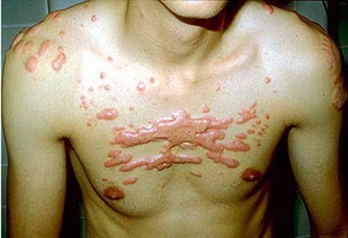 Vêt sẹo vùng ngực co kéo, phì đại lớn và có màu đỏ sẫm Vêt sẹo vùng ngực co kéo, phì đại lớn và có màu đỏ sẫm