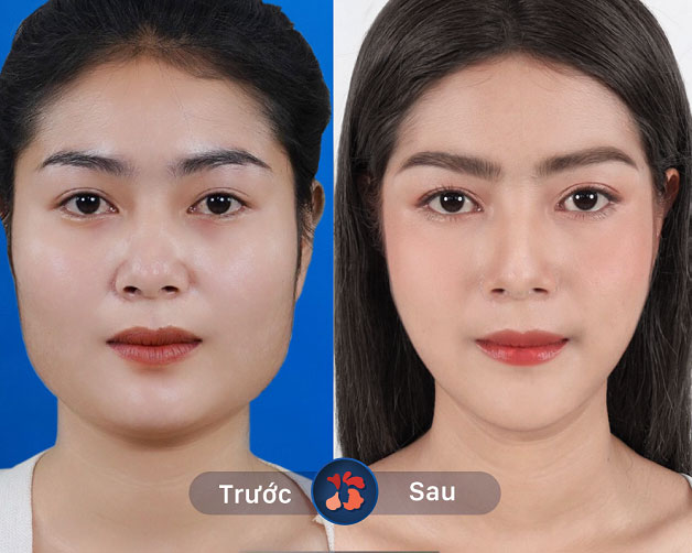 Hết cằm bạnh, vuông chỉ sau 1 ca phẫu thuật gọt hàm