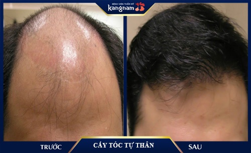 công nghê cấy tóc đau không? cấy tóc đau không