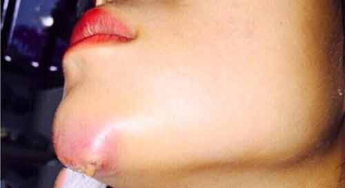 Trường hợp độn cằm bị hỏng dẫn đến hoại tử tại cơ sở chui không có giấy phép hoạt động Trường hợp độn cằm bị hỏng dẫn đến hoại tử tại cơ sở chui không có giấy phép hoạt động