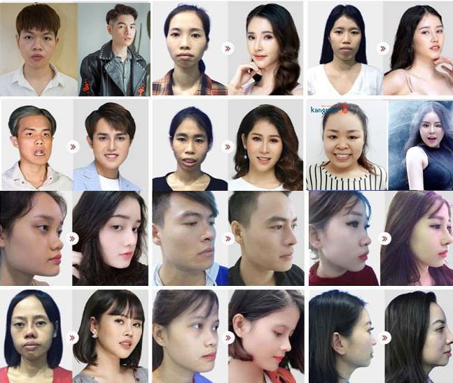 Hàng ngàn ca đại phẫu hàm mặt được thực hiện thành công tại kangnam Hàng ngàn ca đại phẫu hàm mặt được thực hiện thành công tại kangnam