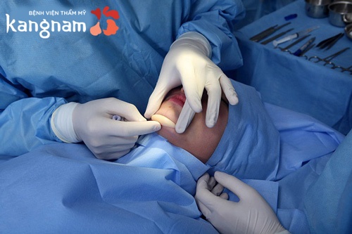 Độn cằm là phẫu thuật đơn giản, không xâm lấn đến xương hàm mặt Độn cằm là phẫu thuật đơn giản, không xâm lấn đến xương hàm mặt