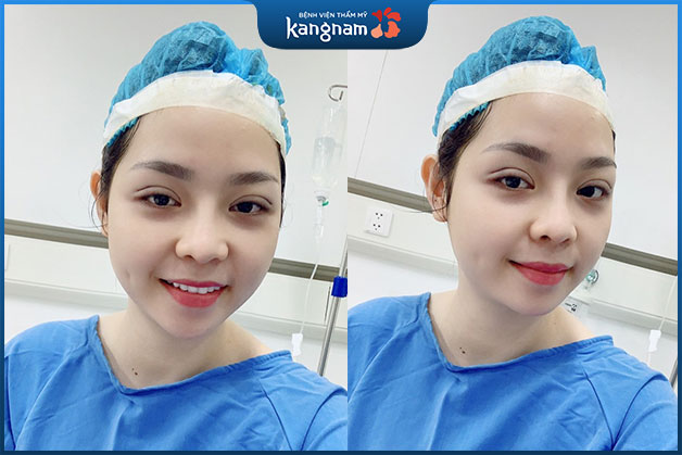 Nhấn mí không gây hại, không nguy hiểm nếu thực hiện tại cơ sở uy tín.