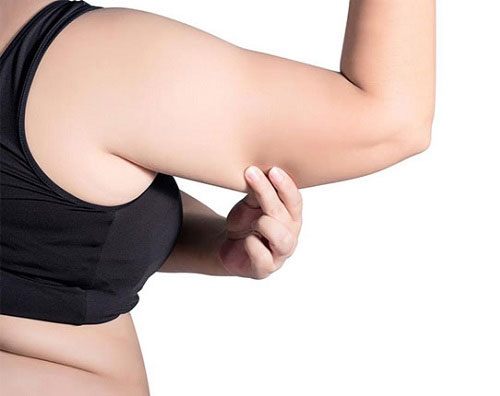 Tăng cân quá mức là nguyên nhân chính khiến mỡ thừa tích tụ tại bắp tay.