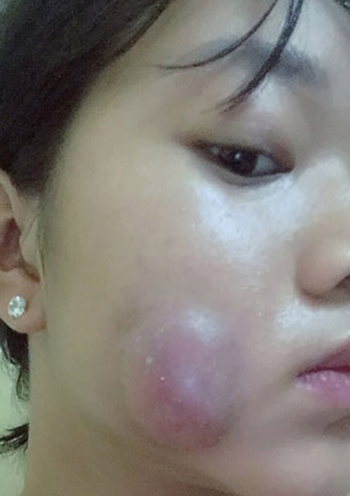 hậu quả làm má lúm đồng tiền