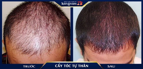 Cấy tóc giúp giải quyết triệt để tình trạng hói vùng trán, trả lại vẻ đẹp mái tóc và sự tự tin cho khách hàng hình ảnh cấy tóc