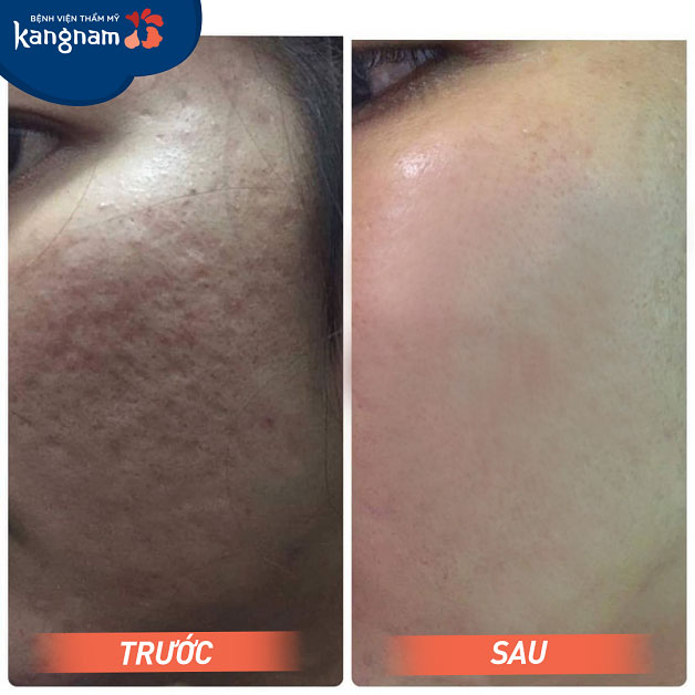 Tạm biệt sẹo rỗ do mụn