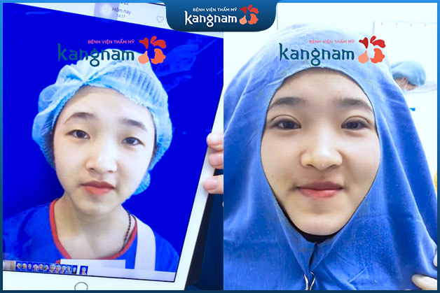 Bấm mí ở đâu đẹp nhất hà nội