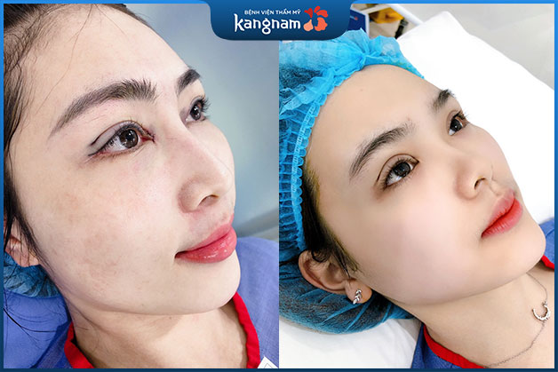 Hình ảnh thay đổi khác biệt trước và sau khi bấm mí.