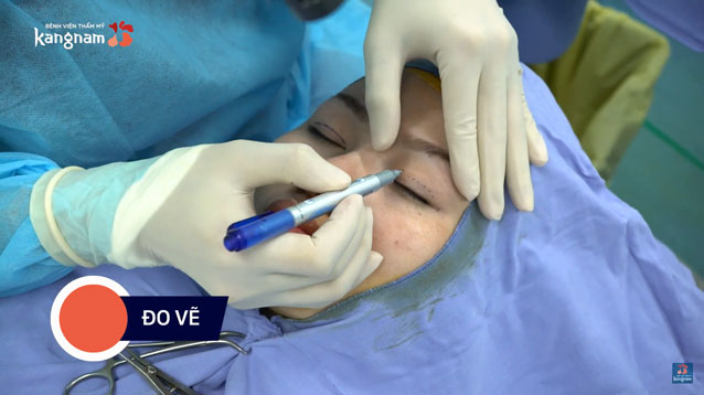 Bác sĩ trực tiếp đo vẽ phác thảo tỷ lệ chuẩn trước khi nhấn mí