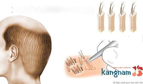 Cấy tóc tự thân mang tới nhiều ưu điểm vượt trội so với các phương pháp lạc hậu trước đây kĩ thuật cấy tóc