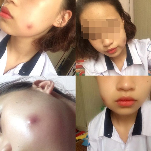 làm má lúm bị mưng mủ