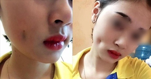 làm má lúm đồng tiền bị hỏng