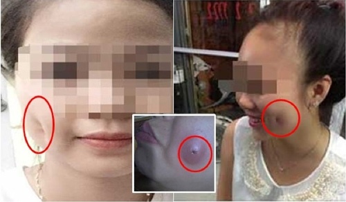 làm má lúm đồng tiền bị hỏng 