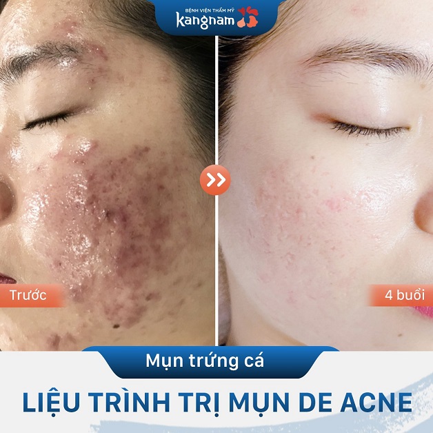 Khắc phục triệt để mụn đỏ sưng viêm ở trán và 2 bên má