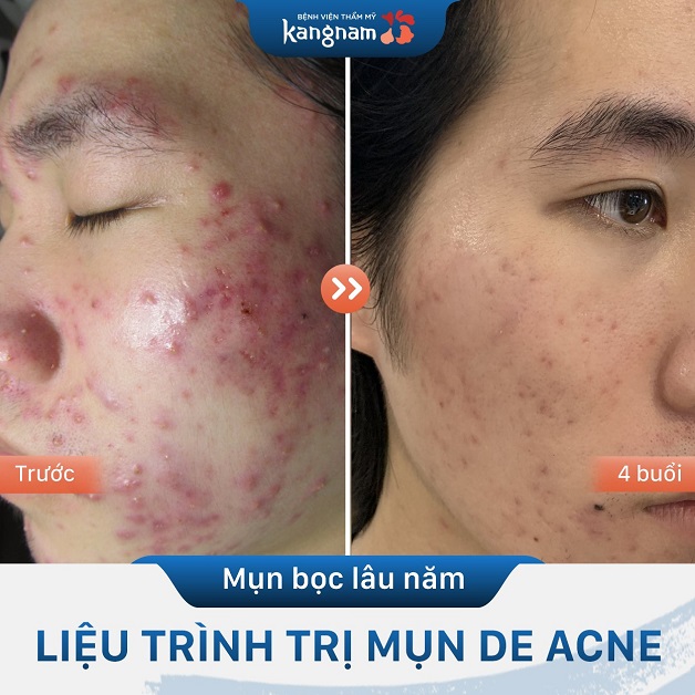 Mụn thâm, mụn ẩn dưới da được khắc chế, làn da sạch mụn và căng mịn hơn