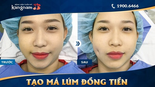 má lúm đồng tiền 