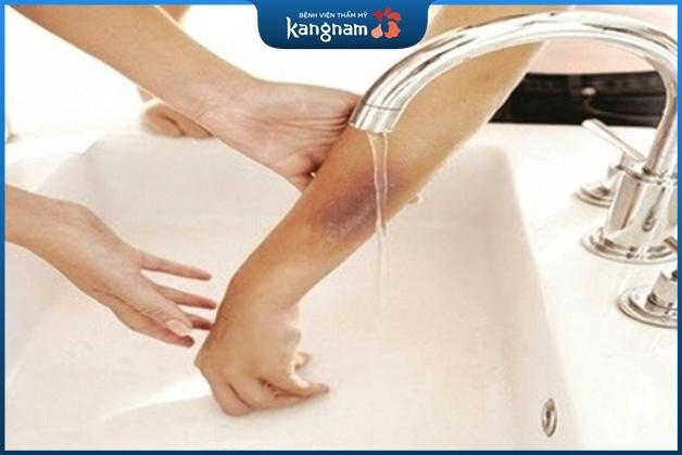 Ngâm vùng da bị bỏng với nước mát ngay để làm dịu vết thương