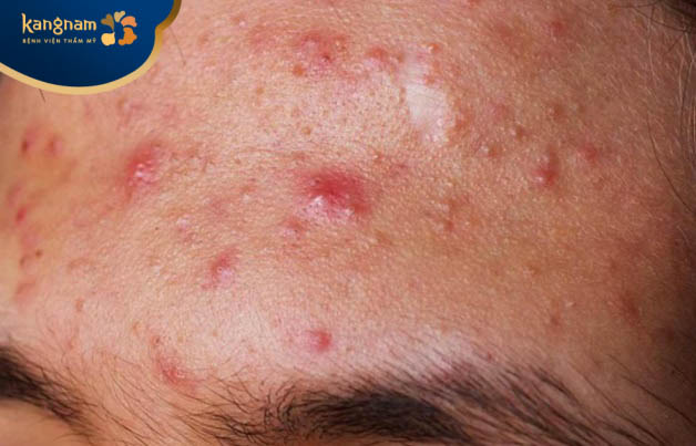 Mụn bọc ở trán là tình trạng thường gặp, nhất là những ai da dầu