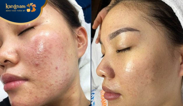 Chị Loan sau 4 buổi điều trị mụn ở Bệnh viện Kangnam