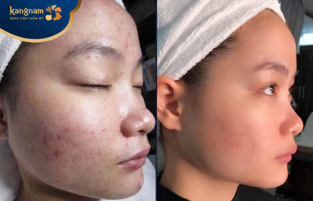 Khách hàng Tiên đã sạch mụn sau 5 buổi điều trị