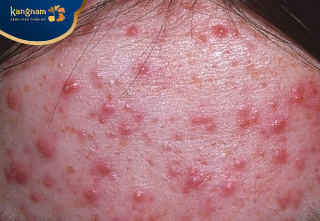 Mụn mủ ở trán