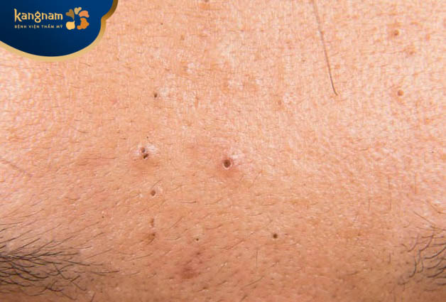 Mụn đầu đen ở trán