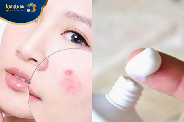 Trị mụn tại nhà bằng kem đánh răng