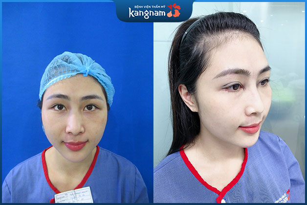 Đôi mắt tròn to hơn sau khi nhấn mí tại Kangnam