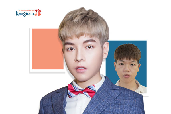 Khuôn mặt thô, bạnh, cằm lẹm được khắc phục hoàn toàn