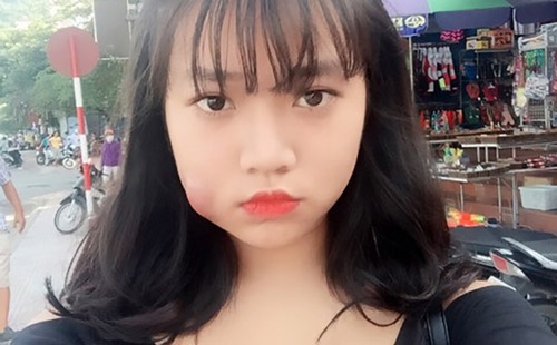 phẫu thuật má lúm bị hỏng 