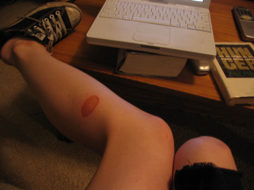 sẹo bỏng bô xe máy