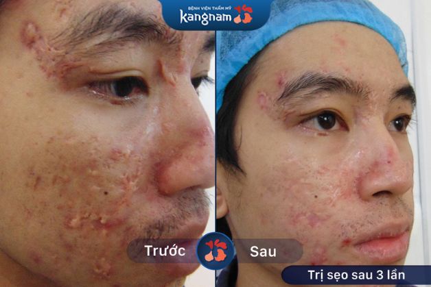 Hình ảnh vùng sẹo co kéo nhiều đã được khắc phục đến 50% sau 2 liệu trình điều trị