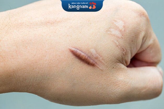 Sẹo lồi hình thành do tăng sản quá mức Collagen trong quá trình làm liền vết thương