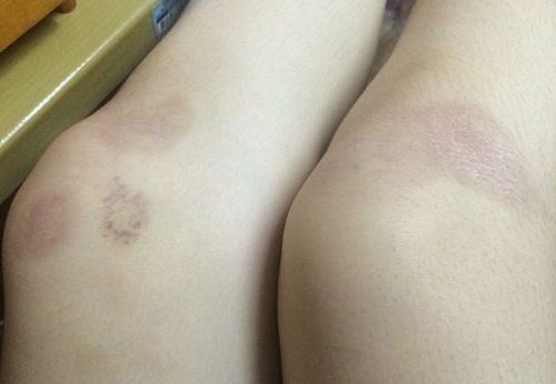 sẹo lồi nặng sẹo lồi nặng