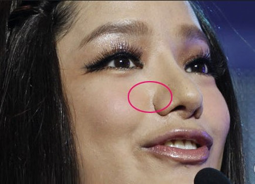 Nguyên nhân gây sẹo lồi trên mũi do phẫu thuật thẩm mỹ cắt cánh mũi hoặc nâng mũi chữa sẹo lồi ở mũi