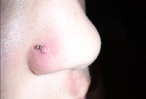 Xỏ khuyễn mũi rất dễ gây nên sẹo lồi không đáng có sẹo lồi ở cánh mũi