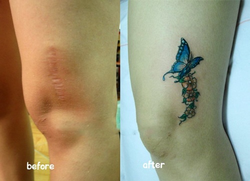 Che sẹo đầu gối bằng cách xăm hình nghệ thuật sẹo lồi ở đầu gối